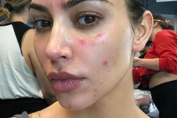 Psoriasis: la enfermedad del estrés y la ansiedad que padece Kim Kardashian