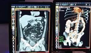 Medicina nuclear, especialidad para tratar el cáncer, Alzheimer y Parkinson