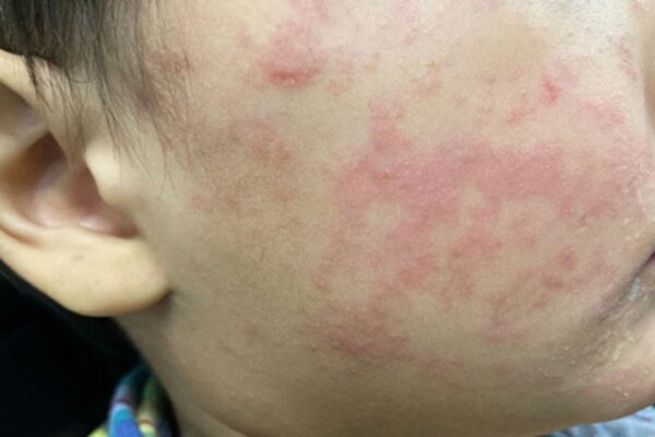 Casos de sarampión se extienden a 25 estados