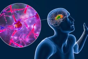 Investigadores ingleses desarrollan nueva inyección para la enfermedad de Huntington