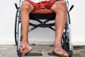Poliomielitis, enfermedad viral que afecta nervios de médula ósea
