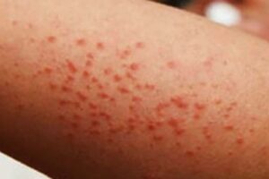 Sarampión se expande por todo México; piden vacunarse