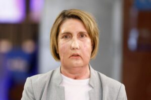 Realizan el primer trasplante facial del mundo con donante que recibió la eutanasia