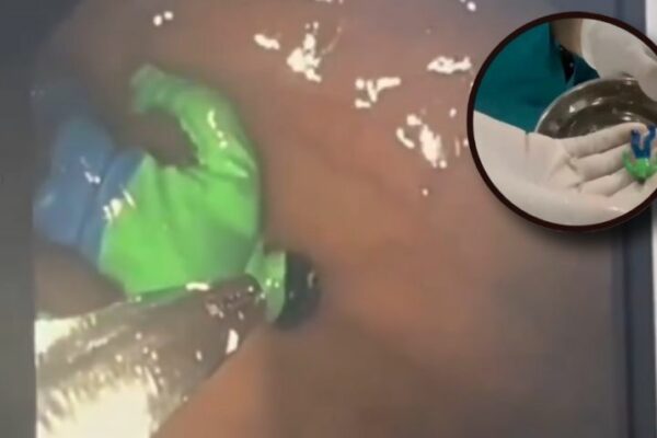 Niño tenía un fuerte dolor y médicos descubren un “Hulk” en el estómago