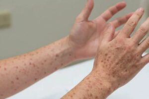 Prohíben visitas a centro de detención de migrantes en Texas por brote de sarampión