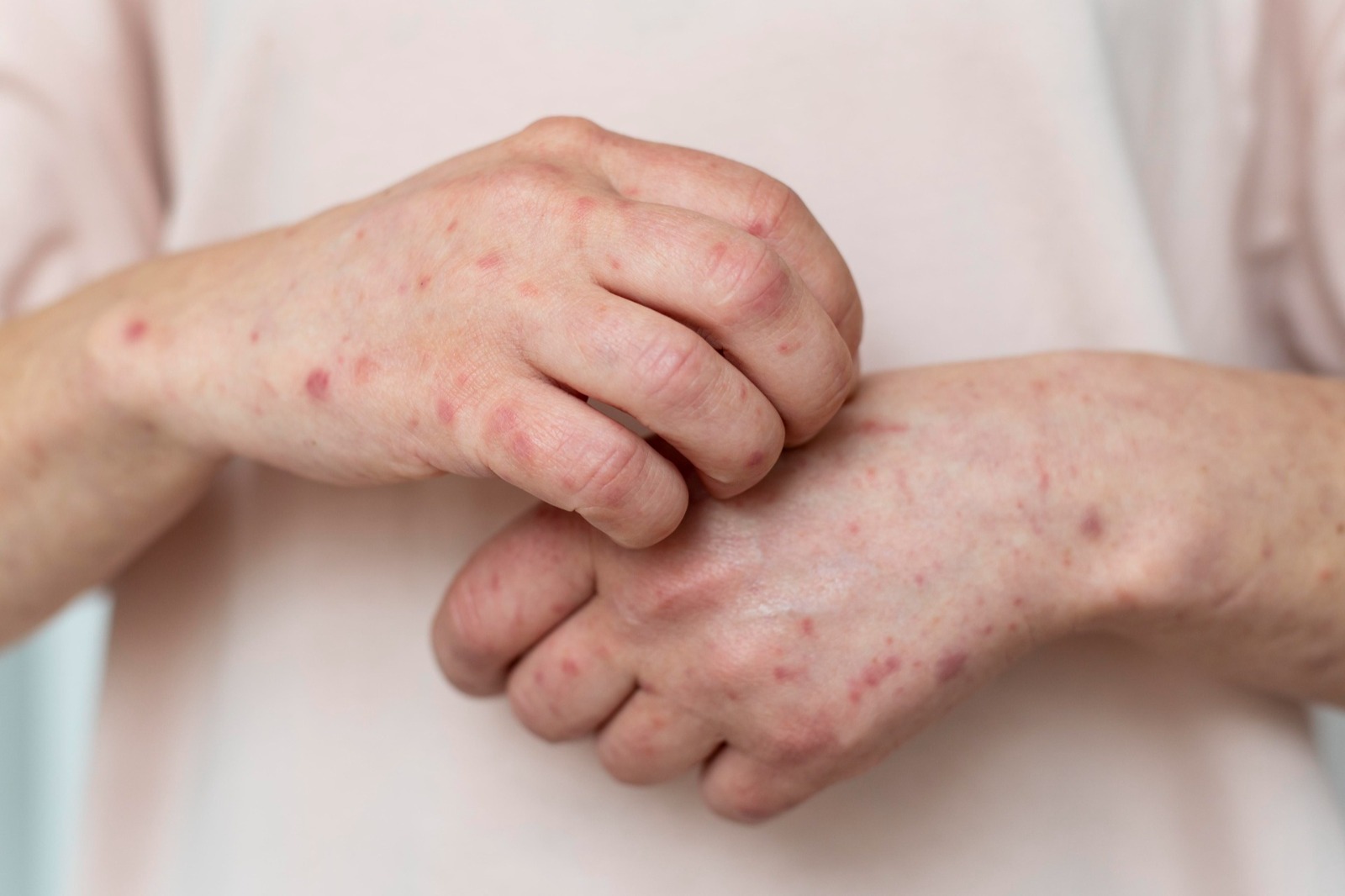 Casos de sarampión en México durante 2026 ya superan el total del año pasado